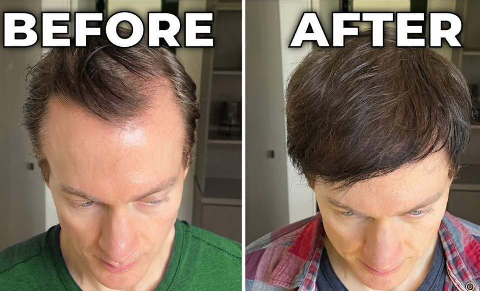 Bryan said he was able to reverse hair loss in 12 months