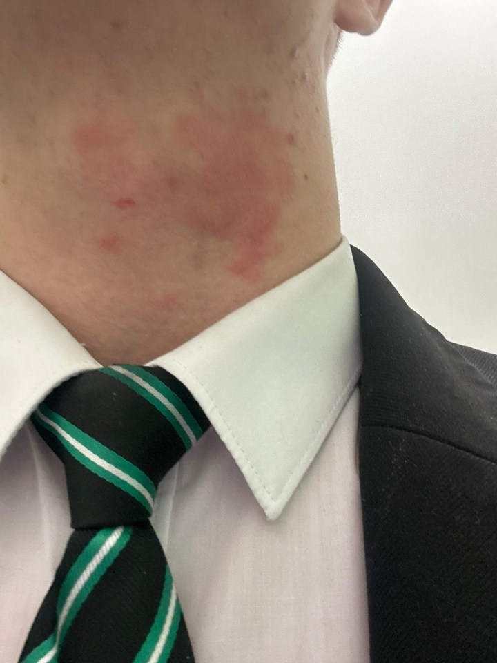 a man with a green and white striped tie has red spots on his neck