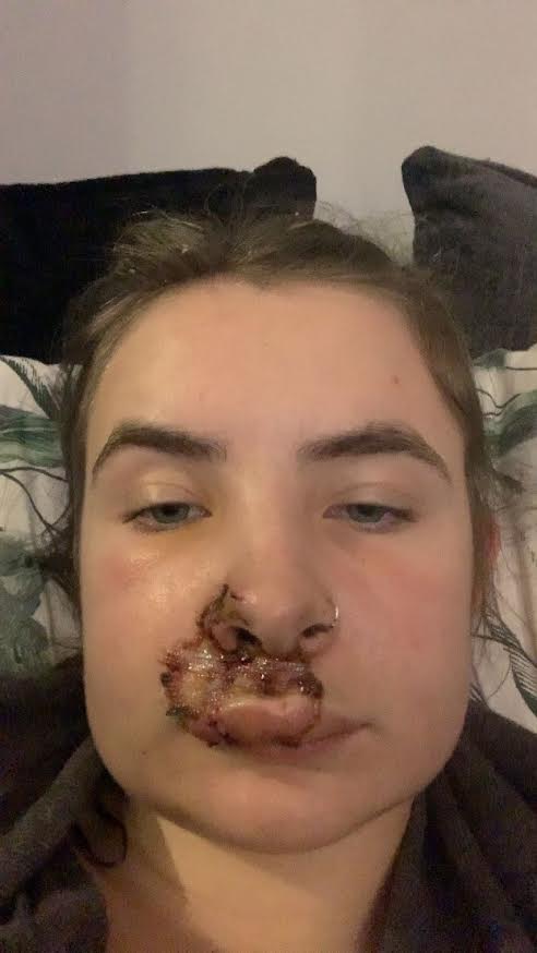 Ella required a two-and-a-half-hour reconstructive NHS procedure to fix the damage caused to her face