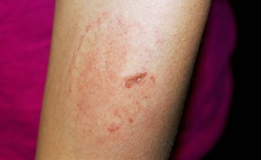 a close up of a person 's arm with a rash on it