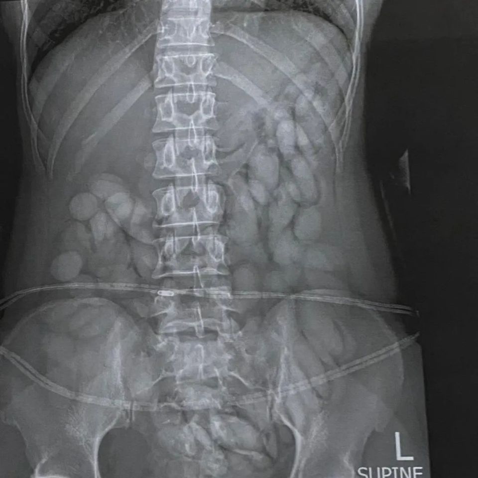 A South African woman was arrested with 68 'cocaine bullets' in her stomach