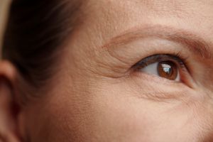 Having crows feet could mean you are more likely to develop dementia