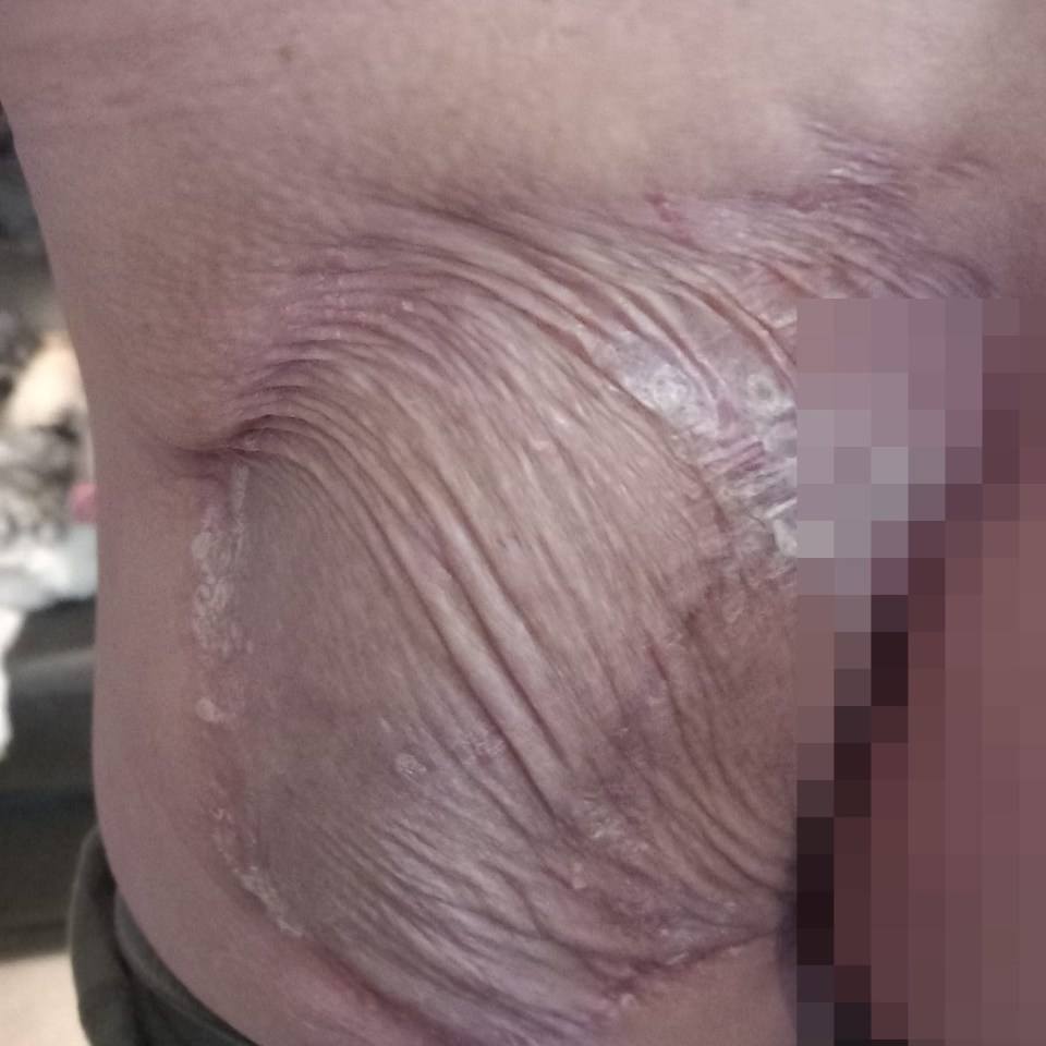 Simon’s skin after the second skin graft on his left buttock