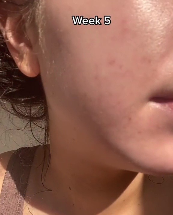 She showed how much her skin had improved by week five of the regime