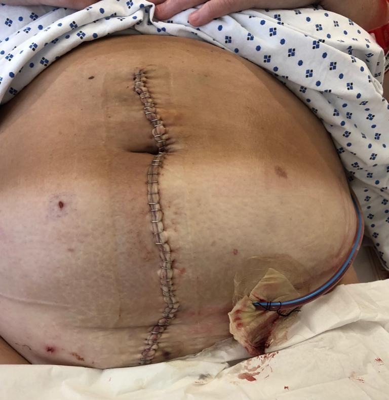 Paula's scar post-surgery