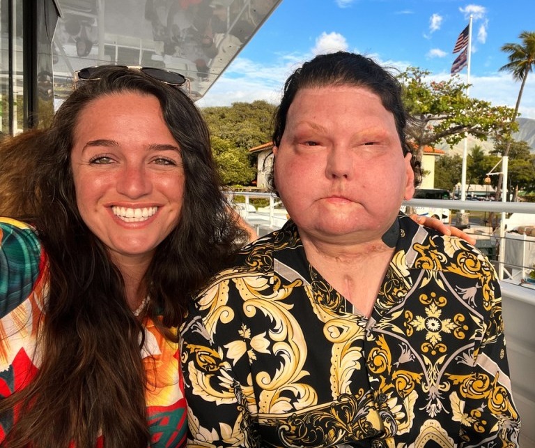 Jessica met Joe eight months after his face transplant