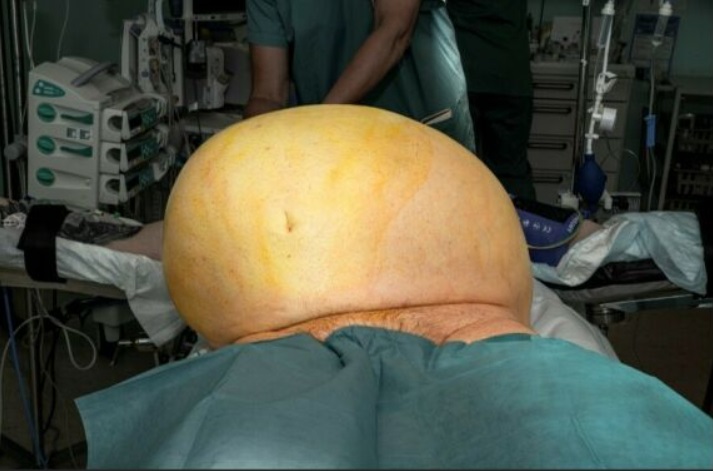 Doctors only found the giant tumour as the prepped him for weight-loss surgery