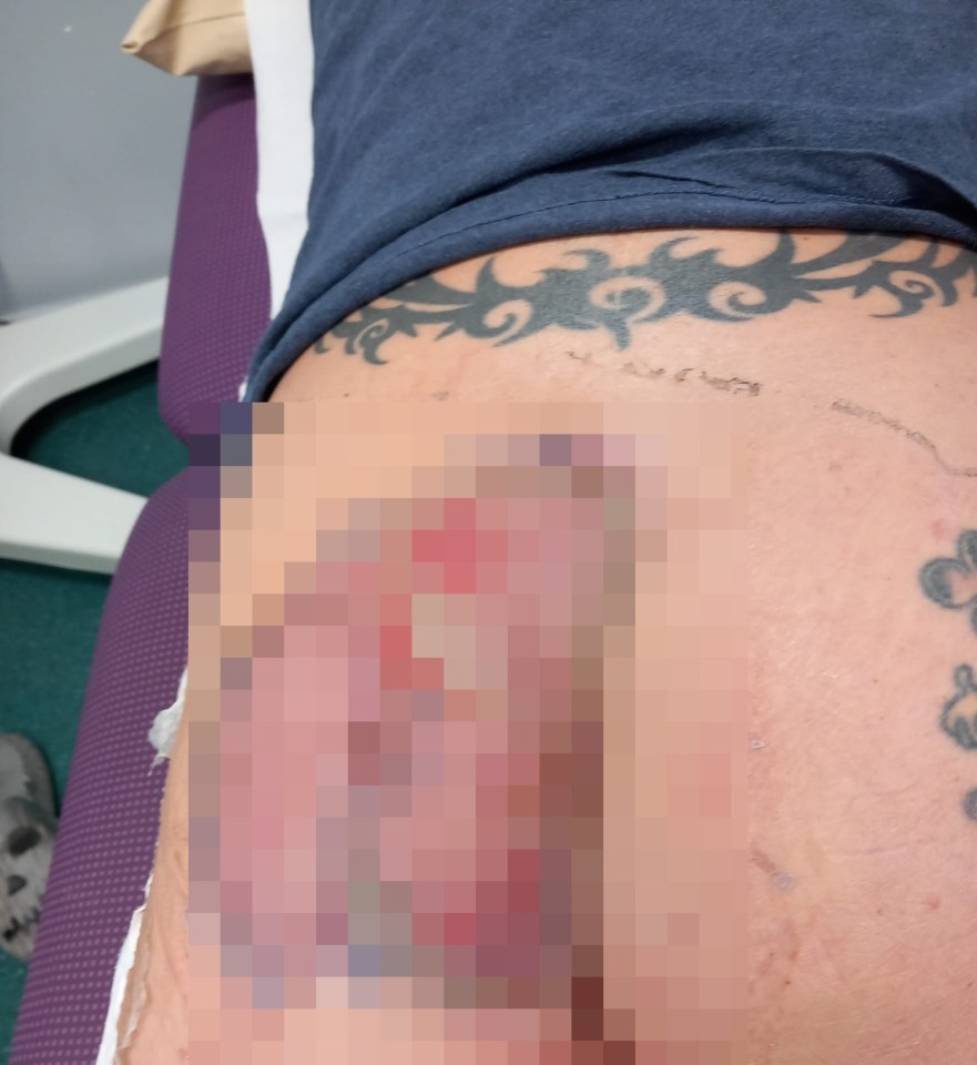 He underwent multiple operations and skin grafts after the infection ate away at the skin of his bum