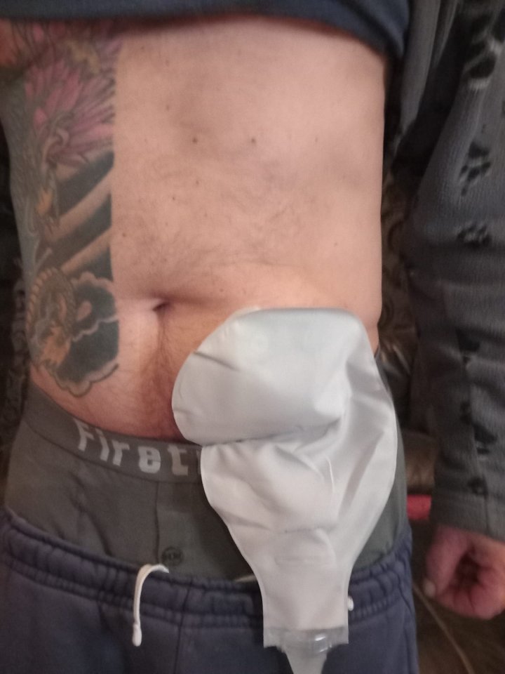 Simon also had a temporary stoma bag fitted