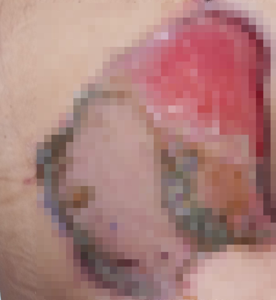 Simon’s skin after the first skin graft on his left buttock, which didn't take