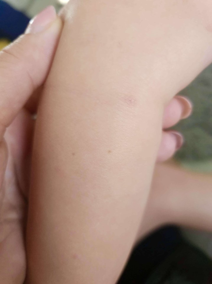 a person is holding a child 's arm with a small spot on it