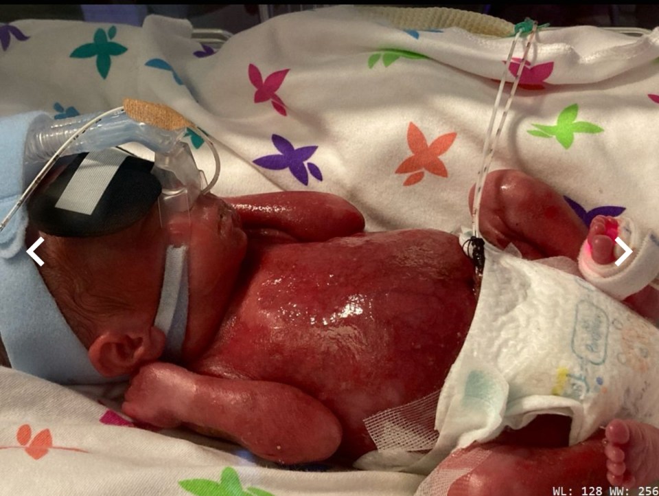 The newborn baby looked like he was ‘burned’ all over his body