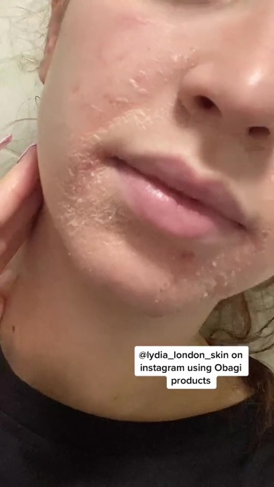 Her skin started shedding around her mouth and chin when she started using the products