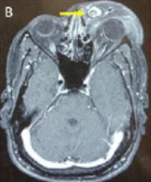 A man in his 30s grew a large tumour after a parasite invaded his eye area