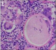 The giant tumour was associated with the parasitic infection rhinosporidiosis, pictured under the microscope