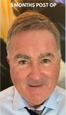 Former Sky Sports host Richard Keys showed off the 'before' shot of his head