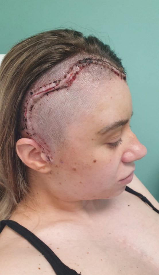 Pic from Kennedy News & Media (Pictured: TIA BRADBURY, 25, AFTER SURGERY WITH 42 STAPLES ON HER HEAD.) A mum claims her declining vision was dismissed by doctors as 'migraines' until she went BLIND - only to discover they were a hidden brain tumour. Tia Bradbury, from Crewe, had been experiencing migraines and eye 'flickering' for months but says doctors dismissed her symptoms as hemiplegic migraines in December last year - without doing any scans. The 25-year-old's vision in her left eyesight was getting worse by the day and she became convinced something more was going on when she noticed personality changes such as irritability. DISCLAIMER: While Kennedy News and Media uses its best endeavours to establish the copyright and authenticity of all pictures supplied, it accepts no liability for any damage, loss or legal action caused by the use of images supplied and the publication of images is solely at your discretion. SEE KENNEDY NEWS COPY - 0161 697 4266