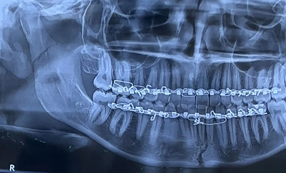 Two bars were inserted into her gums after her jaw was reset