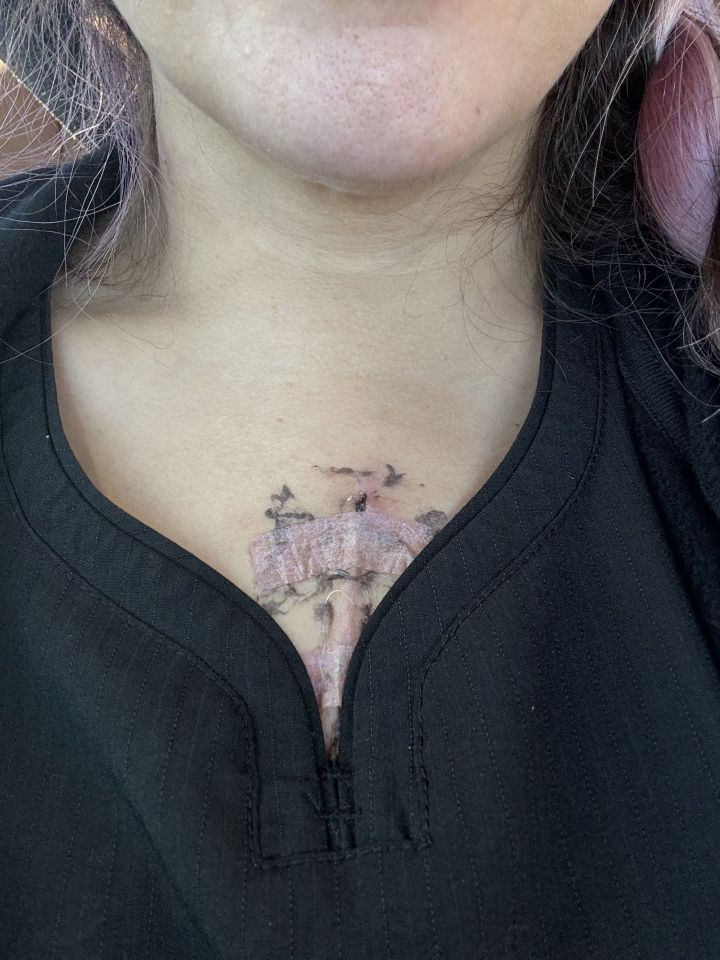 She's been left with scarring across her chest