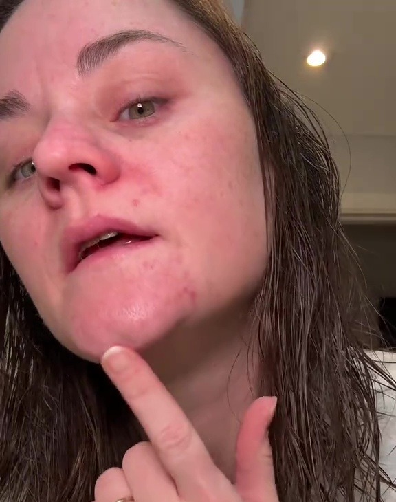 She also regularly got breakouts, as she explained in a video on her TikTok page