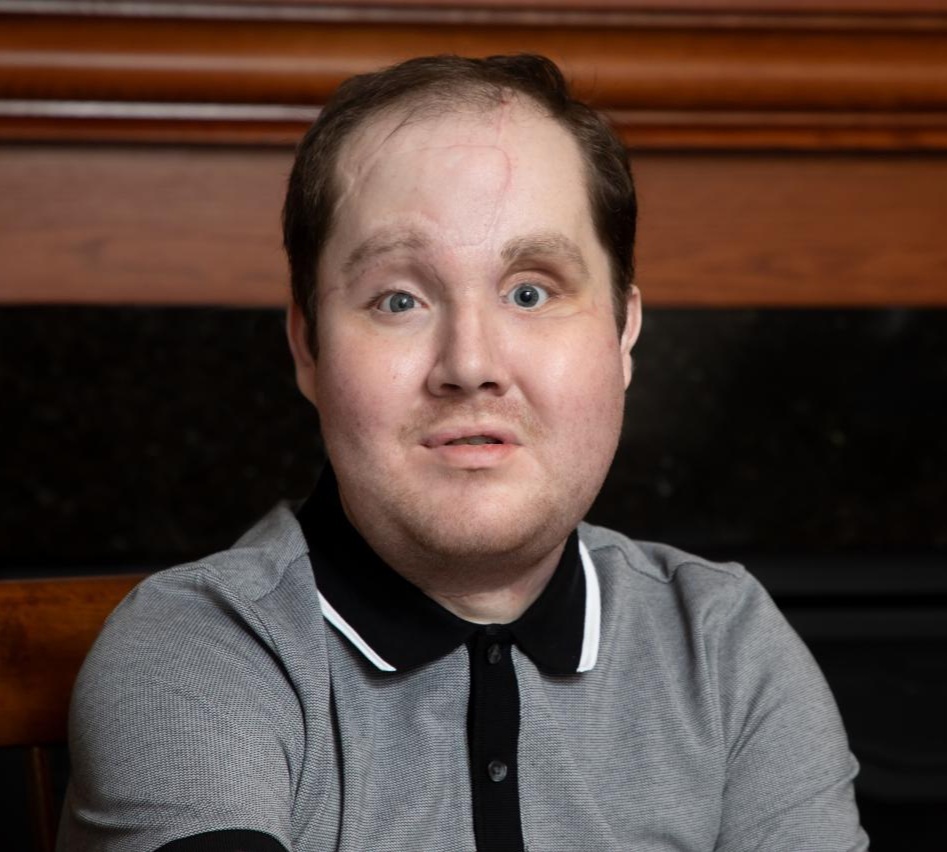 Man with a face transplant looking for a wife.