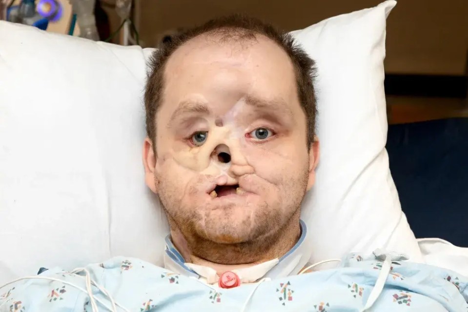 Man in hospital bed after a 50-hour face transplant.