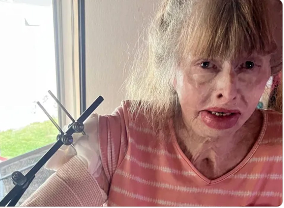 Dorothy has had to have countless surgeries to help her mobility