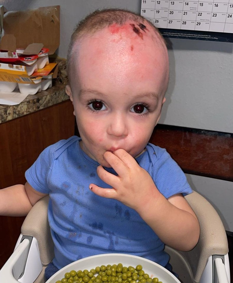 Tate's face healed well but he needed to wear a compression garment on his head because the wounds were scarring