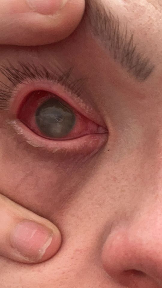 Her eye became sore and itchy but she was fobbed off by doctors for months