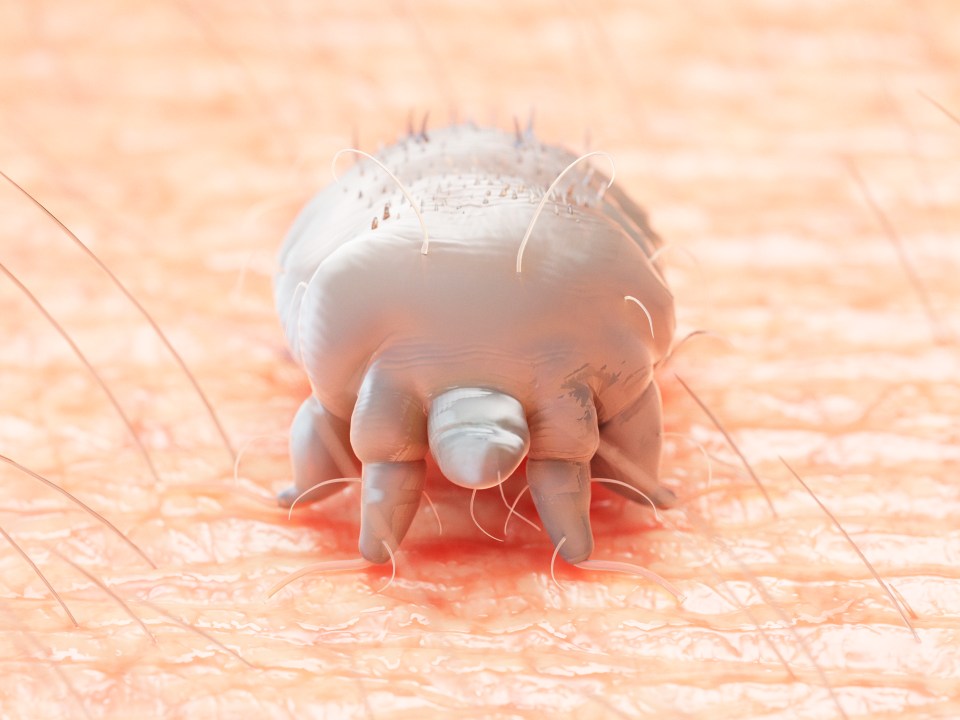 Illustration of a scabies mite on human skin.