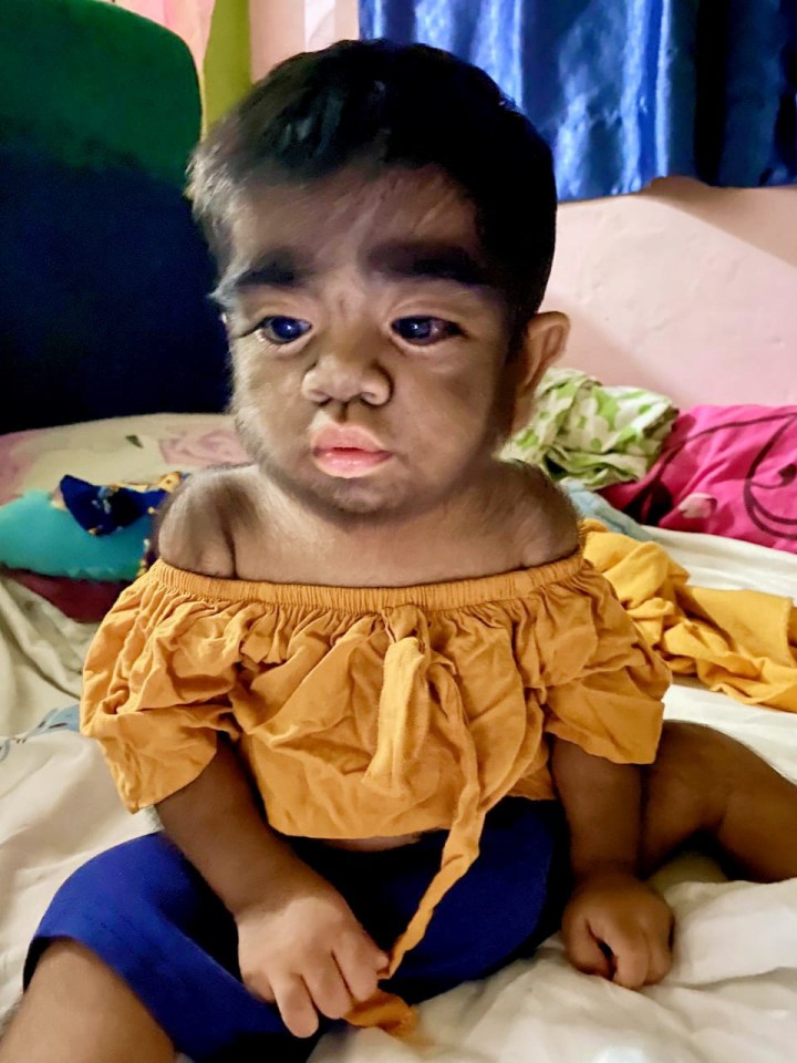 A child with hair covering their face and body due to hypertrichosis