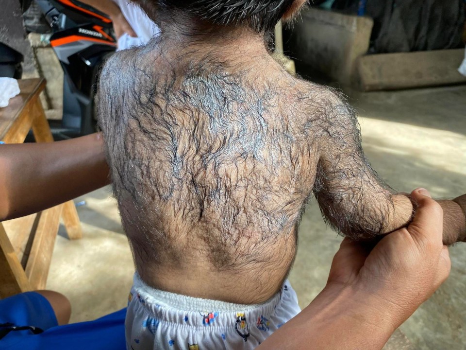 ‘Werewolf syndrome’, or hypertrichosis, causes long, fine hair to sprout from the face, arms, and other parts of the body