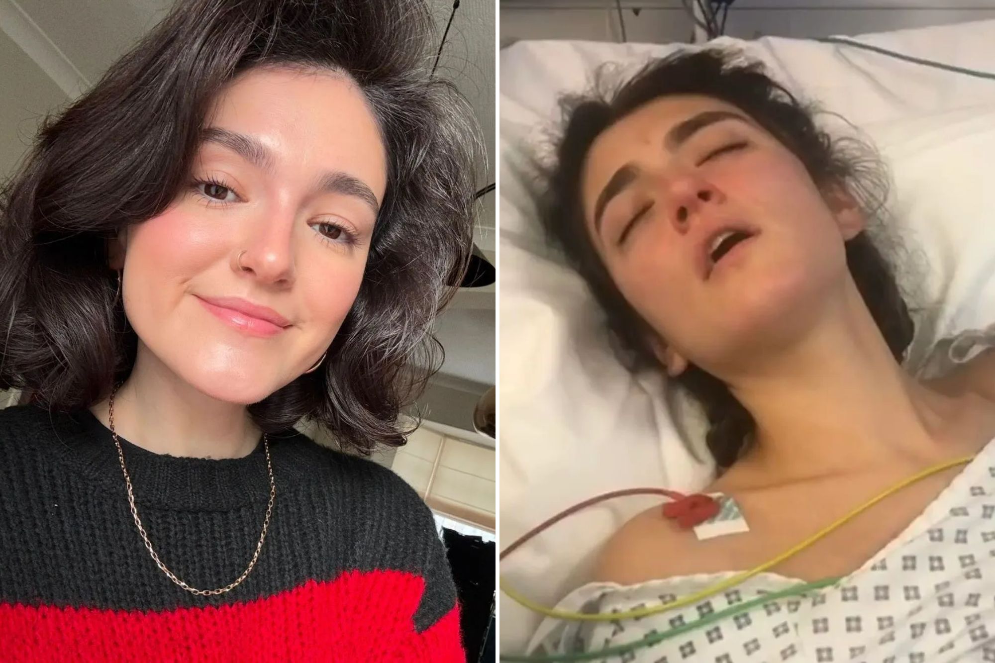 A before-and-after image showing a young woman before and after a medical procedure.