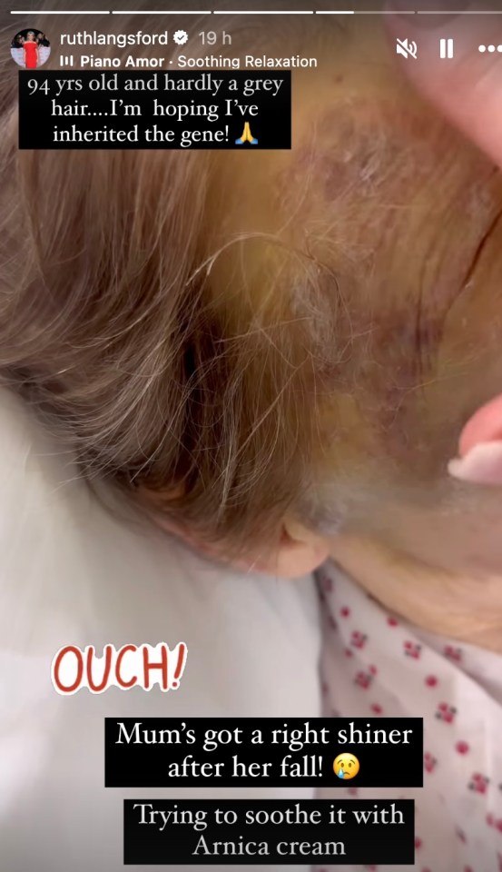 Ruth Langsford has shared a look at her elderly’s mum face bruising after a nasty fall saw her taken to hospital