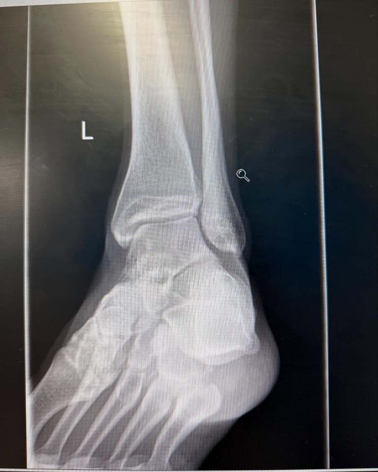 Taking to Instagram, he shared an X-ray scan of his ankle