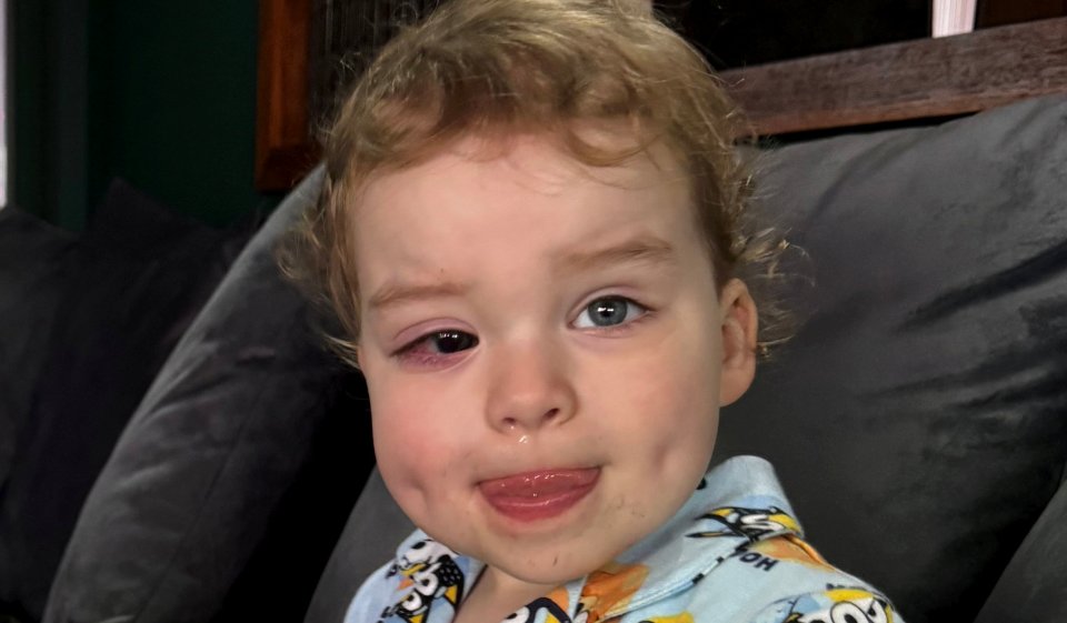 Levi was left blind in one eye after bumping his head in nursery