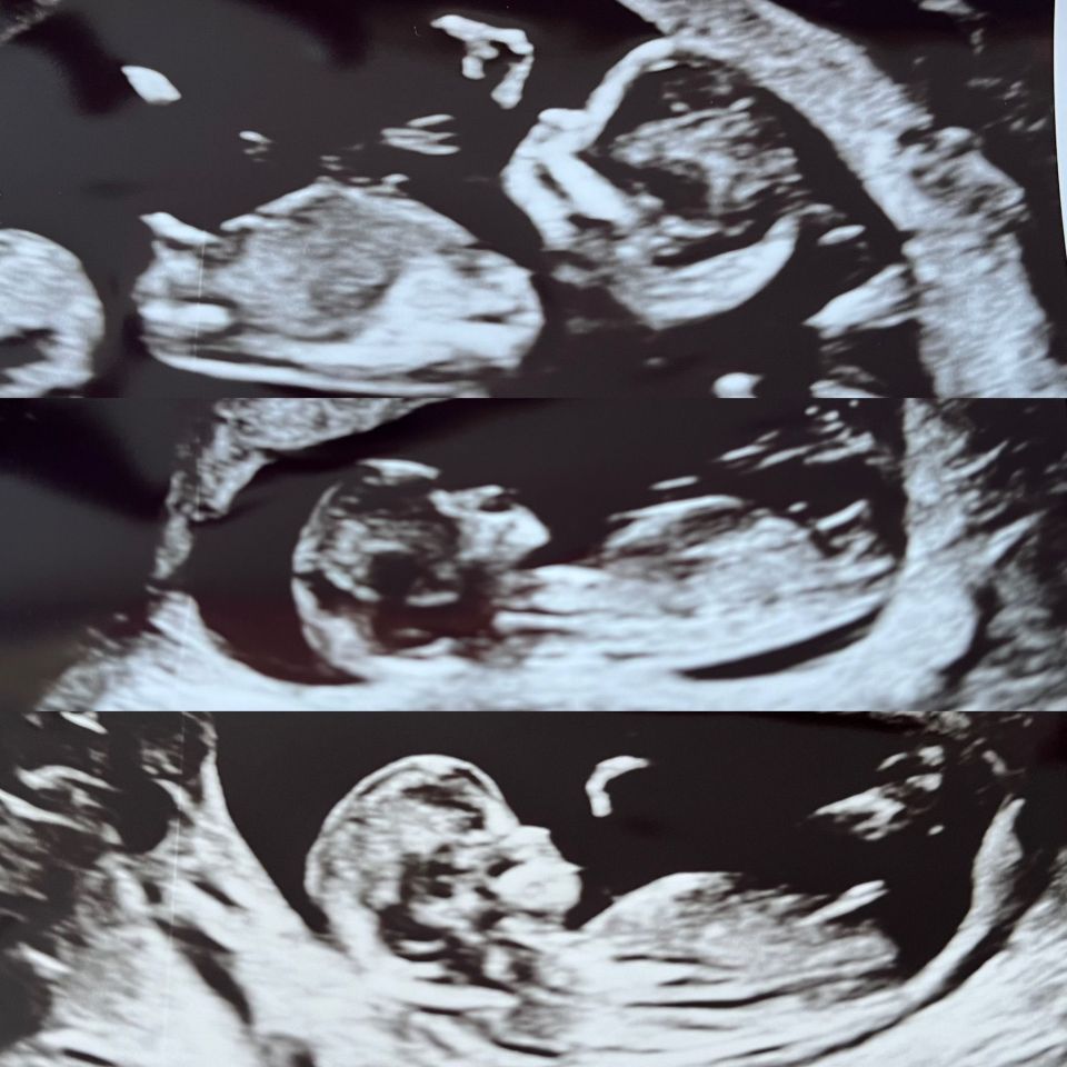 An early scan showing they were expecting three babies before one died