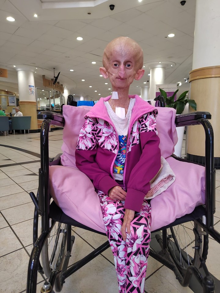 Elderly woman with progeria sitting in a wheelchair.