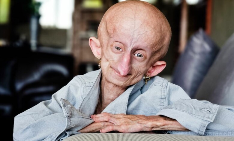 Portrait of an elderly woman with progeria.