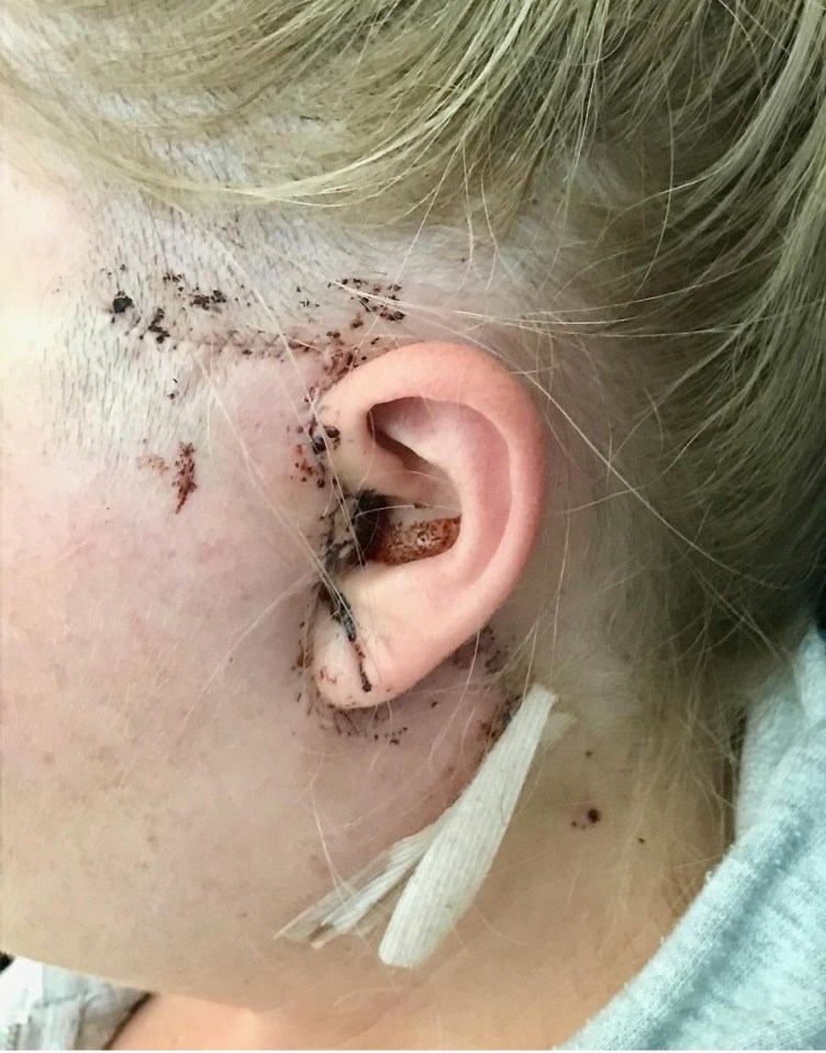 Close-up of a woman's head and neck showing surgical incisions and stitches.