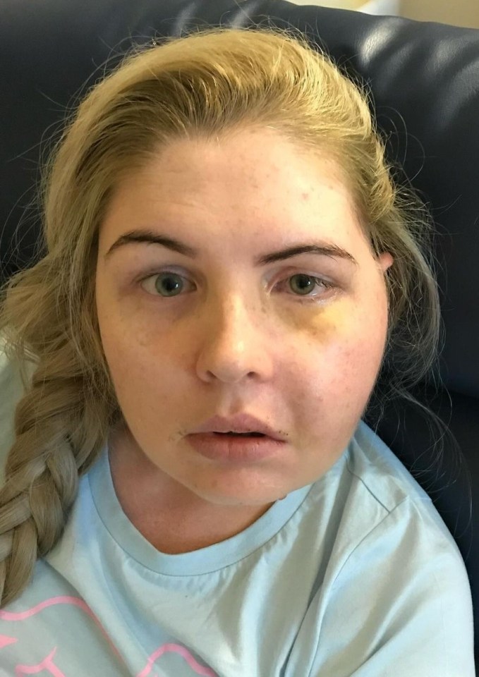 Close-up photo of a young woman with facial swelling and bruising.