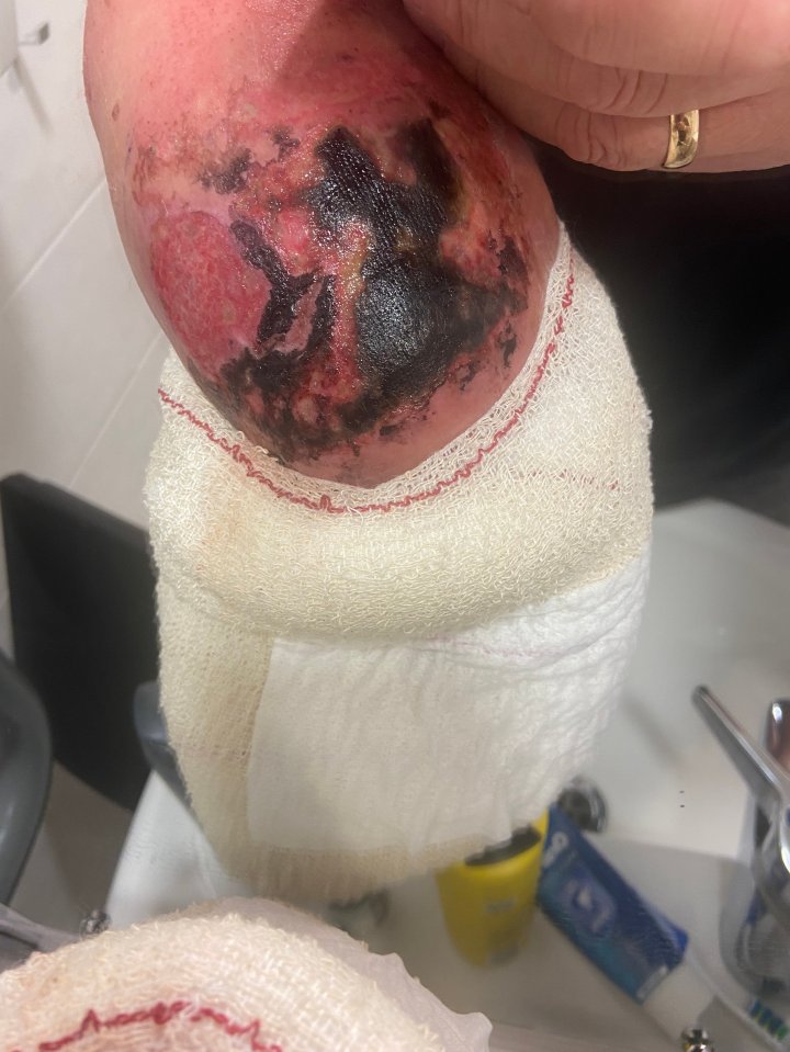 Severe burns on a man's elbow after an electrical shock.