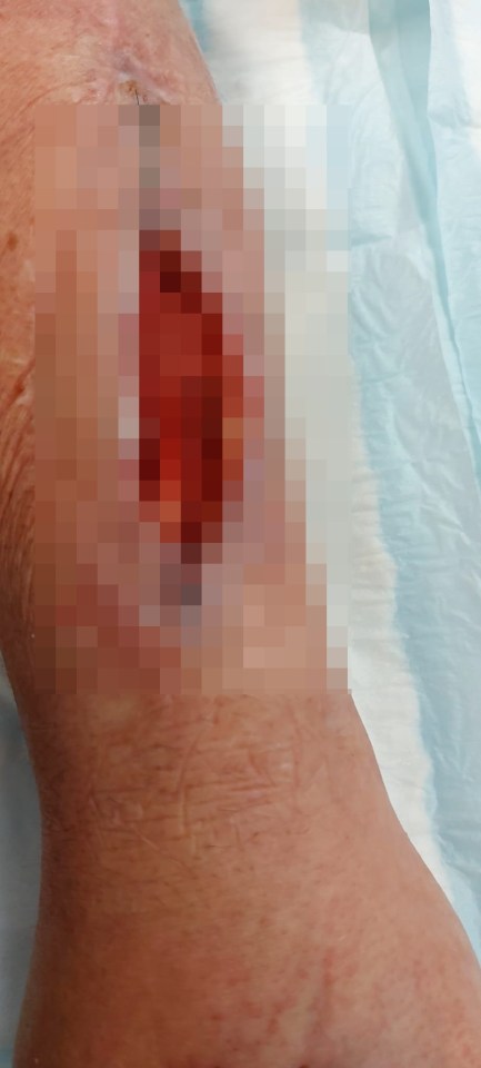 Close-up of a heavily bandaged arm wound.