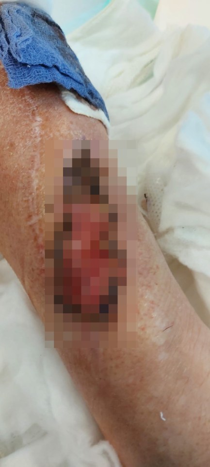 Severely burned and scarred arm after electric shock.