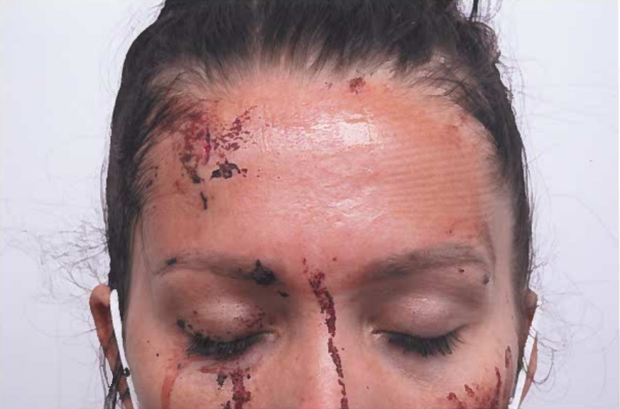 Close-up photo of Kiena Dawes's face showing injuries from an assault.