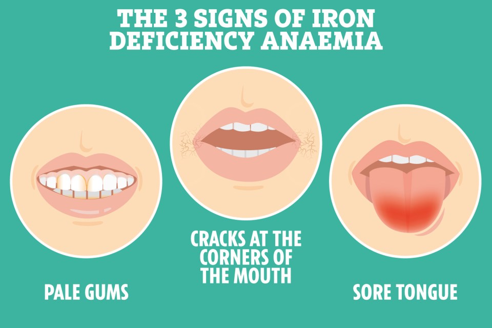 Three signs of iron deficiency anemia: pale gums, cracks at the corners of the mouth, and a sore tongue.