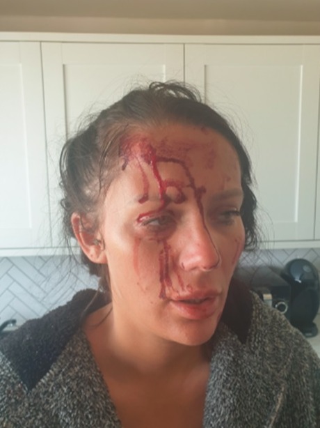 Close-up photo of Kiena Dawes's face showing injuries from an assault.