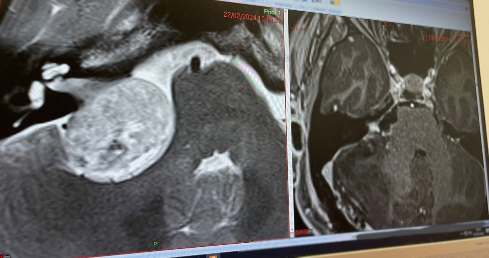 Brain scan before and after tumor removal.