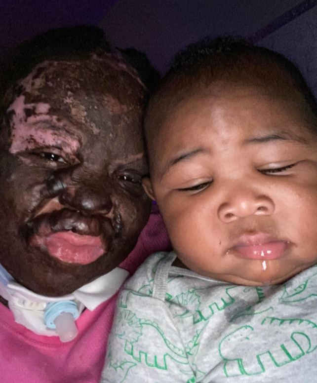 A mother with burn injuries cuddles her baby.