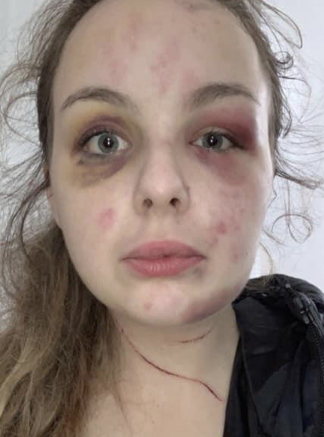 Fantasist Eleanor Williams injured herself with a hammer and posted pictures of her injuries on social media when she was 22